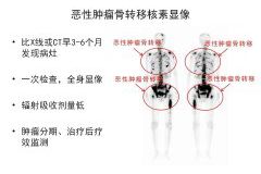 澳门威尼克斯人网站核医学科骨检查与治疗